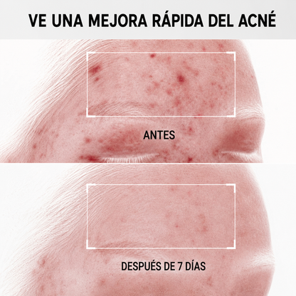 PureSkin™ - Elimina el Acné desde la Primera Aplicación