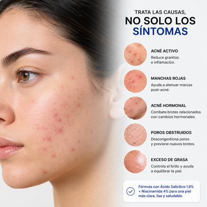 PureSkin™ - Elimina el Acné desde la Primera Aplicación