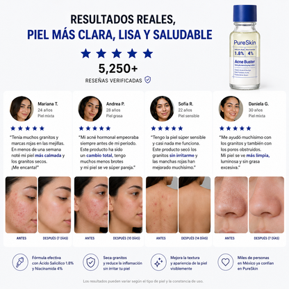 PureSkin™ - Elimina el Acné desde la Primera Aplicación